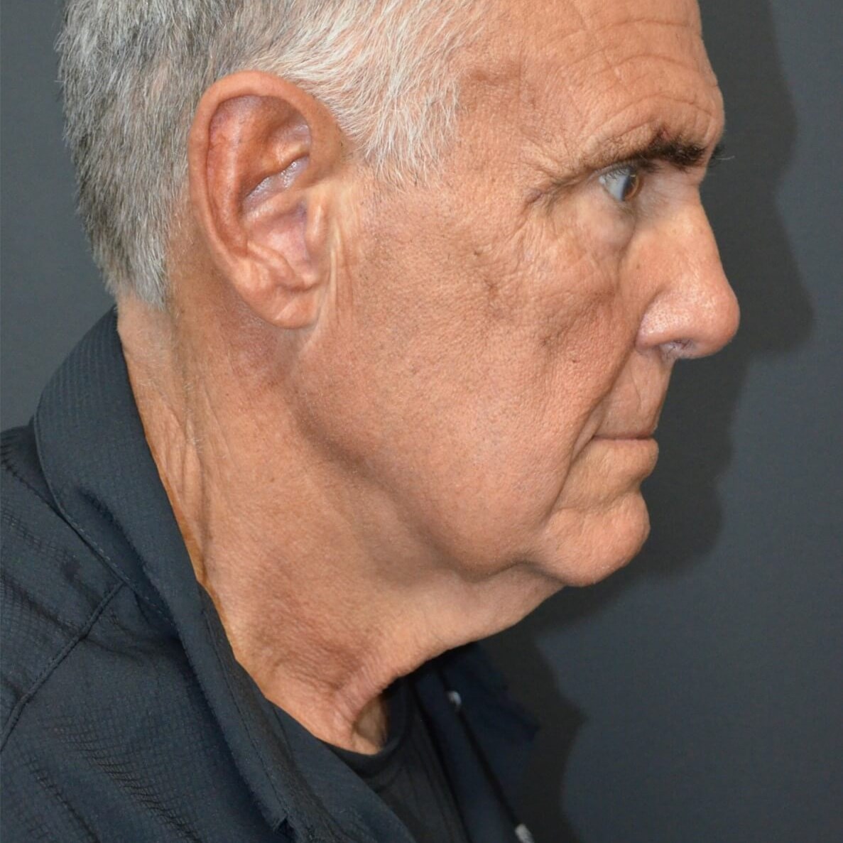 Ideal Candidate for T-Z Neckli